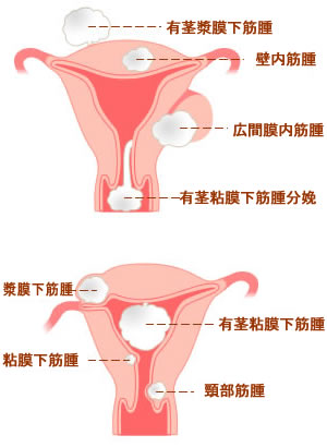子宮筋腫イメージ