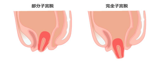 子宮内膜症イメージ