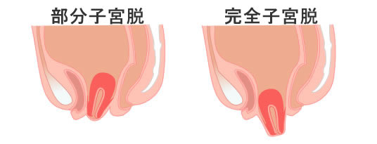 子宮内膜症イメージ